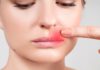 How to Get Rid of a Cold Sore—and Prevent It From Coming Back