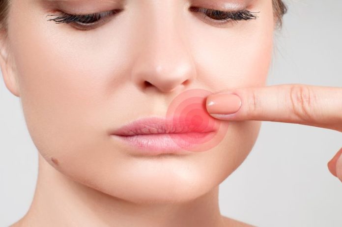 How to Get Rid of a Cold Sore—and Prevent It From Coming Back